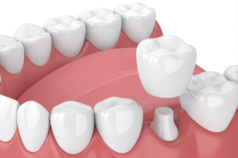 Dental Crowns in North Grosvenor Dale
